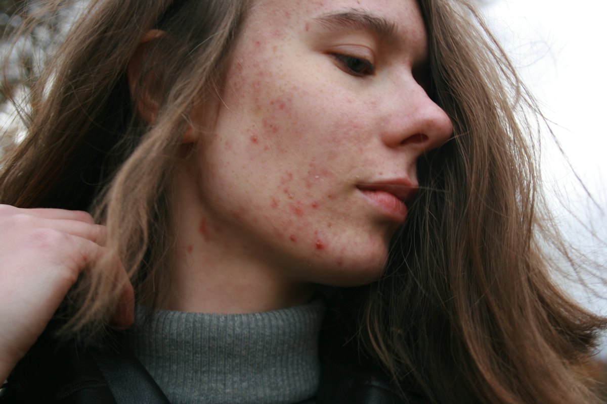 ZO Acne & Oil Control Facial for clients from Corrody