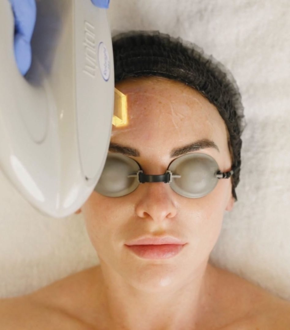 IPL Illumifacial at Skin Deep Aesthetics