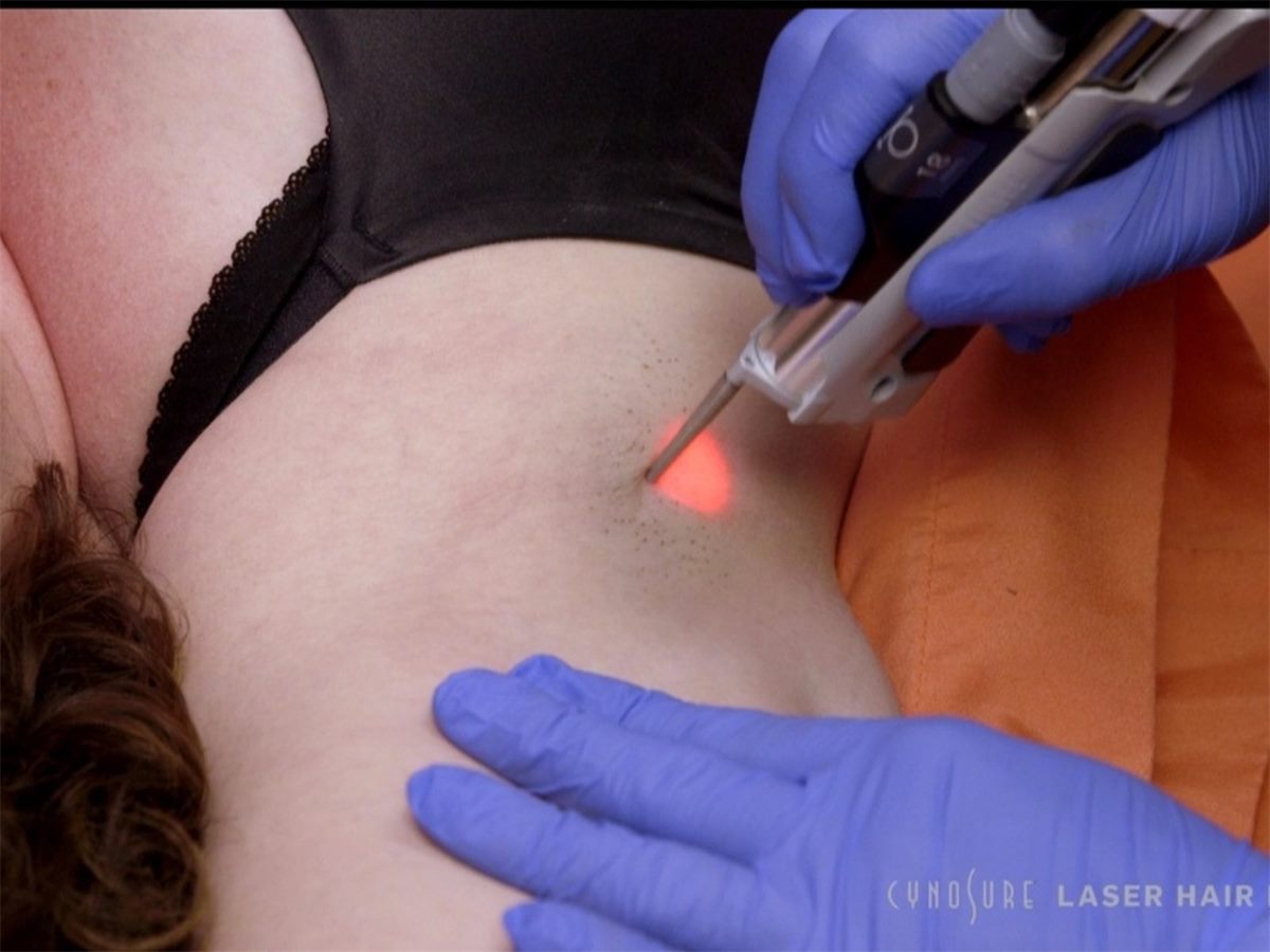 Laser hair removal for women at Skin Deep Aesthetics