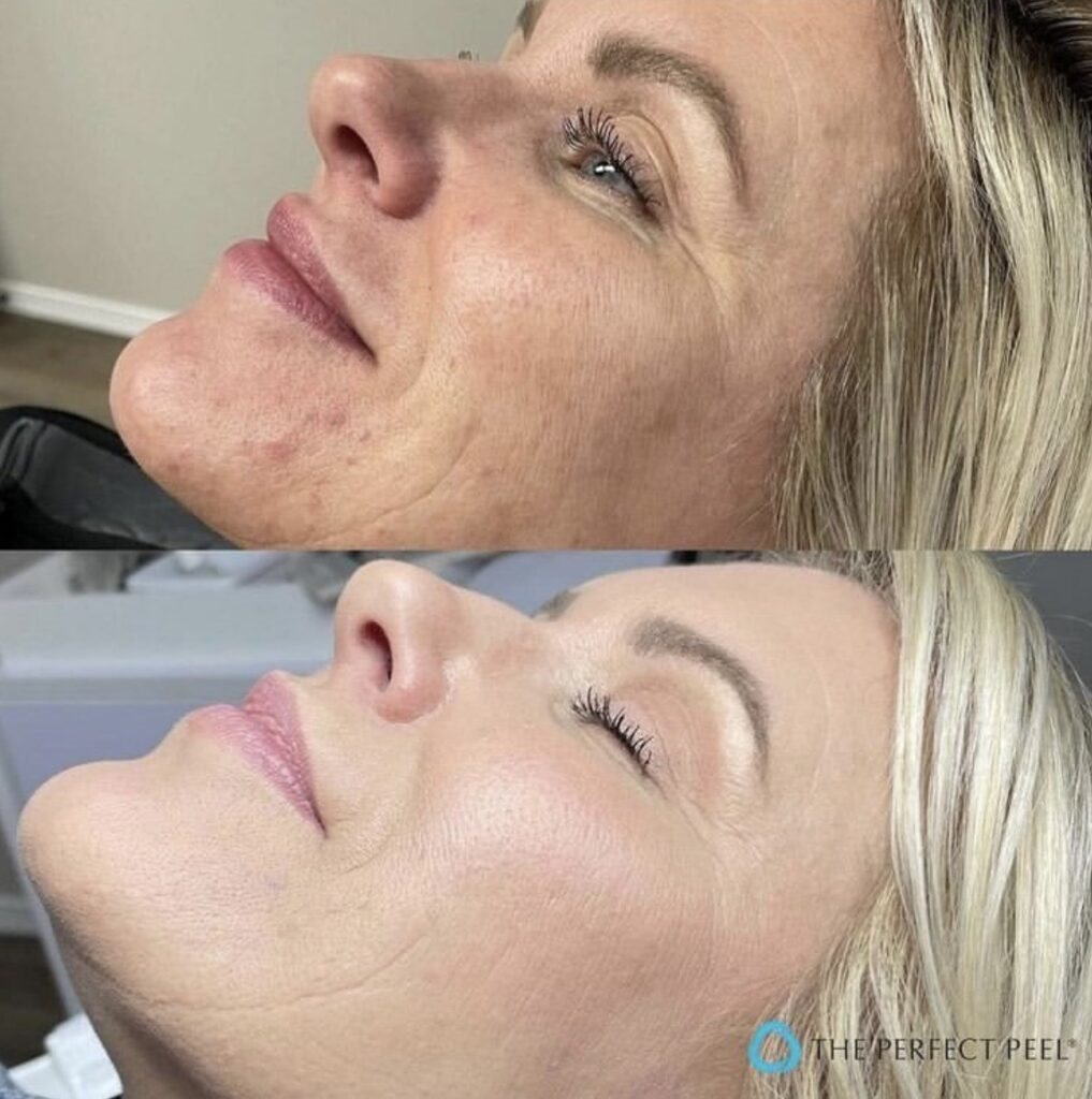 The Perfect Peel at Skin Deep Aesthetics