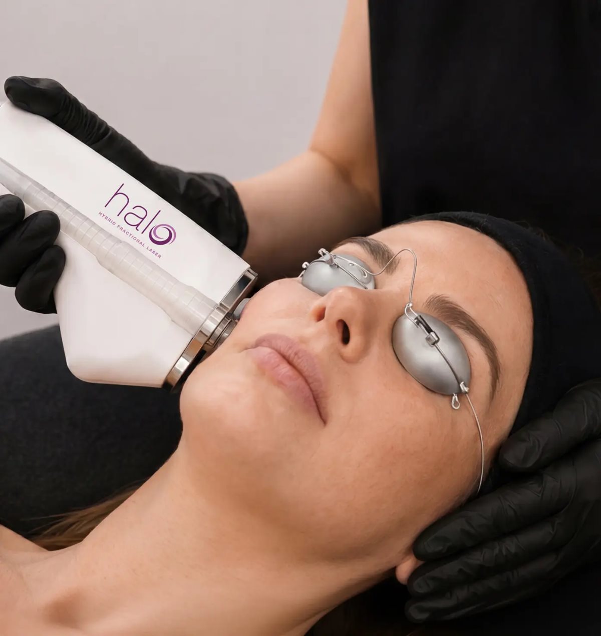 Photo fractional laser hybrid treatment at Skin Deep Aesthetics