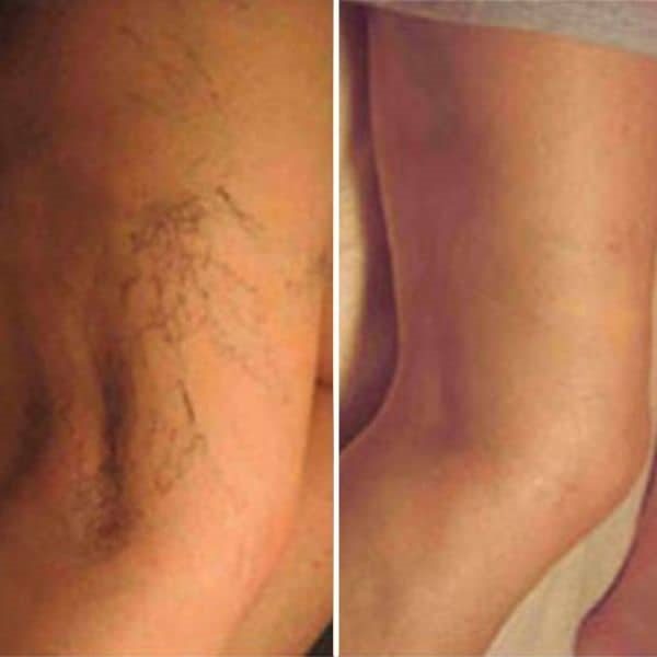 Thread vein removal at Skin Deep Aesthetics